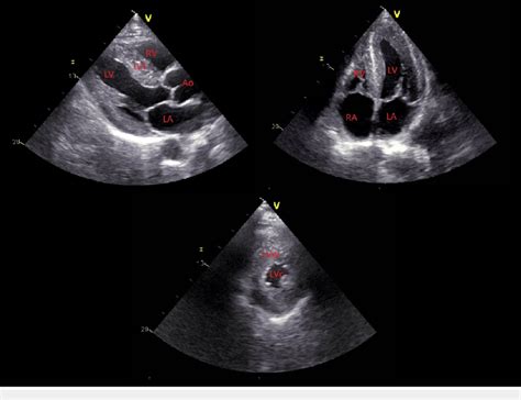 lv hypertrophy on echo.